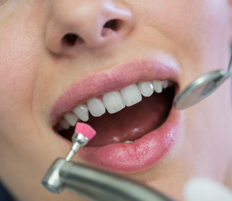 Lucidatura dei denti con coppetta in una seduta di igiene dentale Firenze