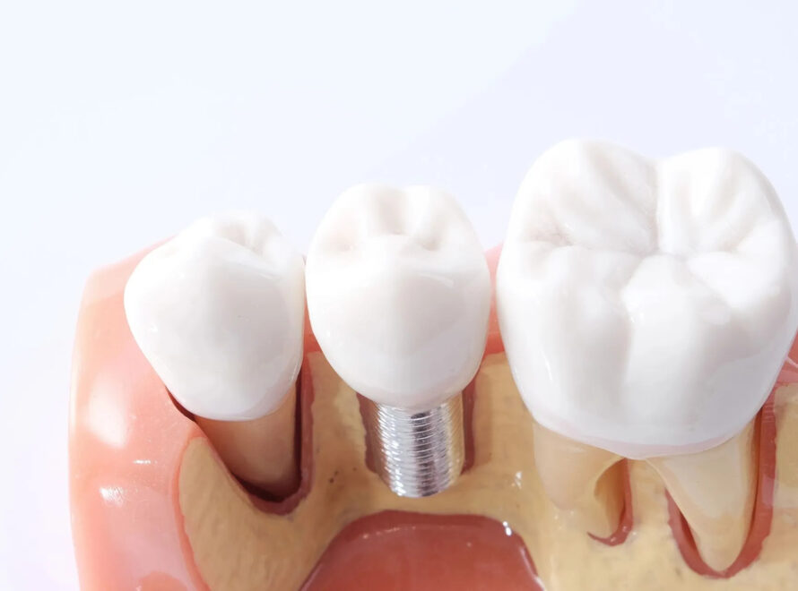 Implantologia a Firenze impianti dentali