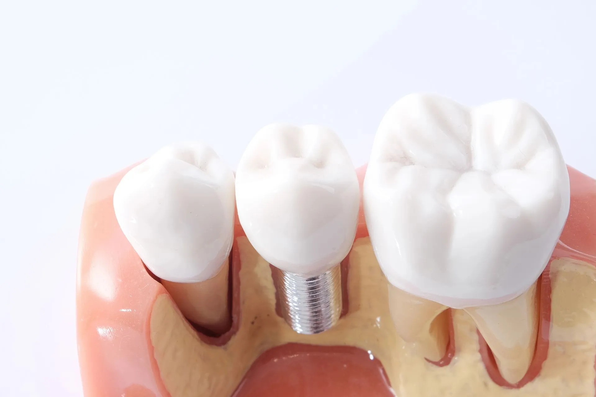 Implantologia a Firenze impianti dentali